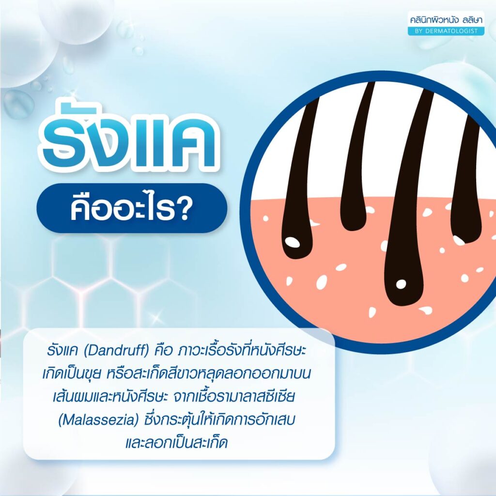 รายละเอียดรังแค