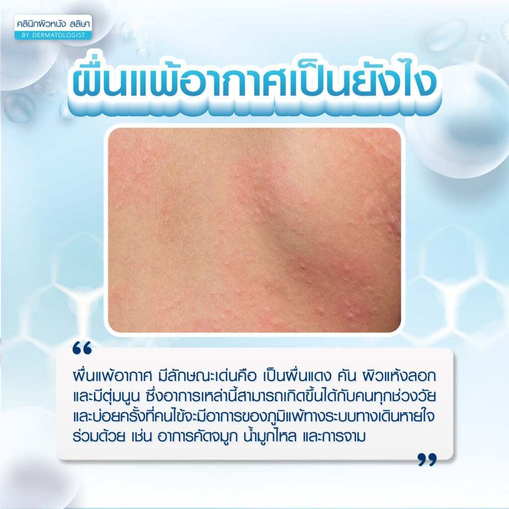 ลักษณะ ผื่นแพ้อากาศ