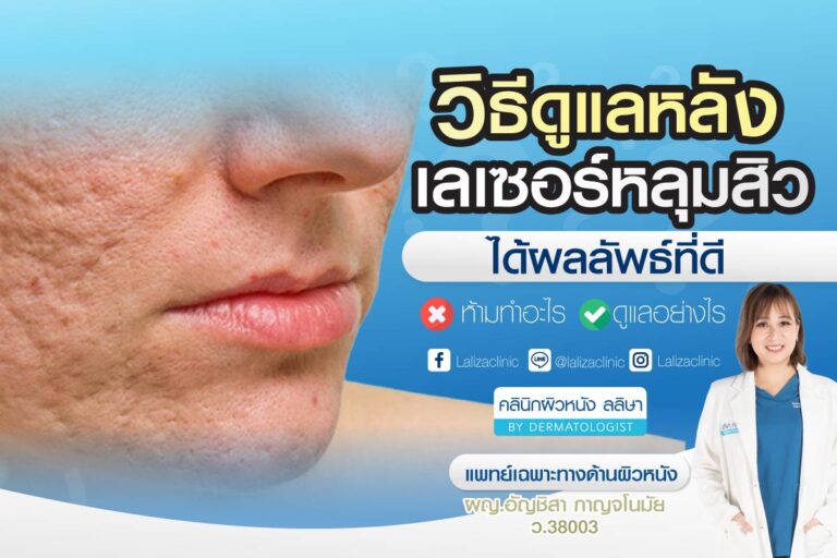 วิธีดูแลหลังเลเซอร์หลุมสิว เพื่อให้ได้ผลลัพธ์ที่ดี