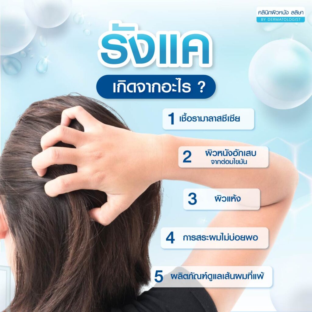 สาเหตุ รังแค