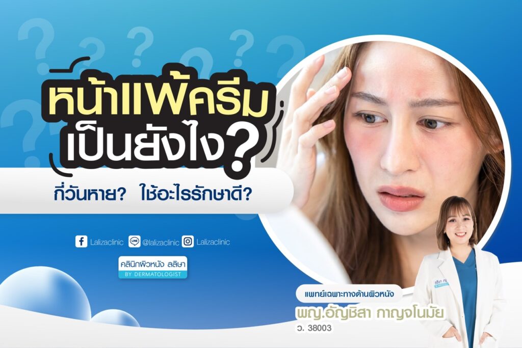 หน้าแพ้ครีม เป็นยังไง กี่วันหาย ใช้อะไรรักษาดี