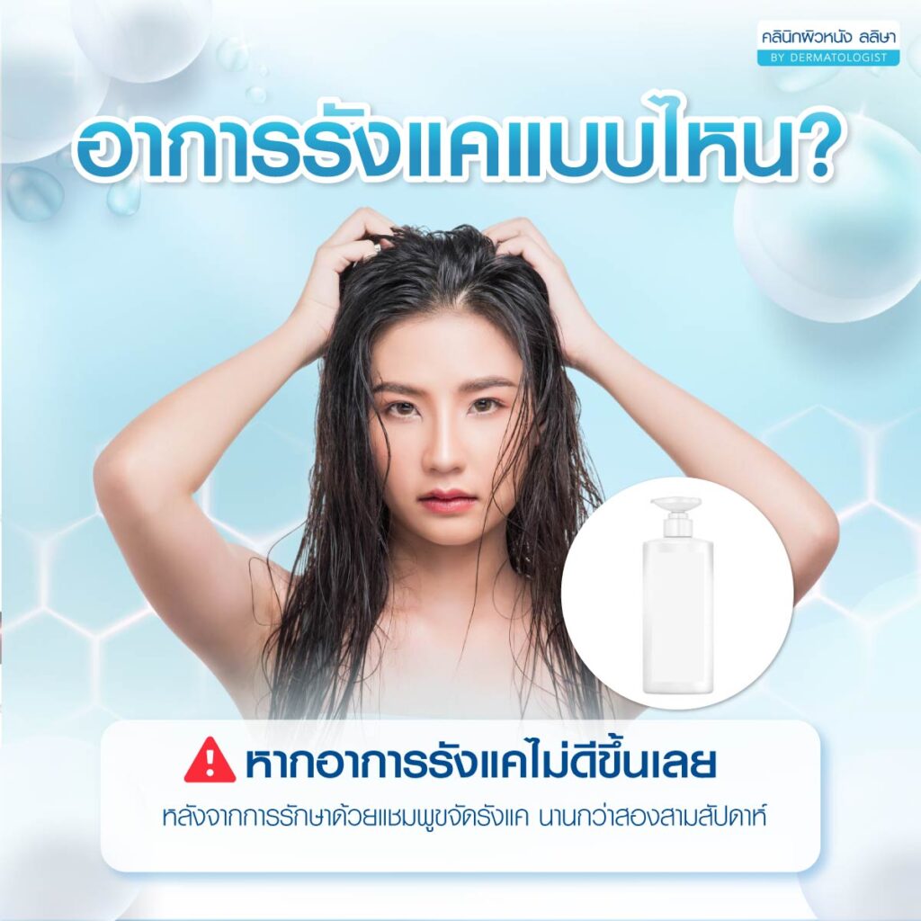 อาการรังแคที่ควรรีบพบแพทย์