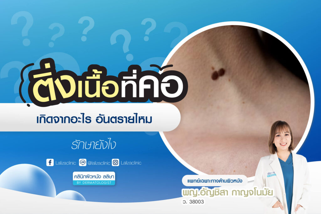 ติ่งเนื้อที่คอ สาเหตุและการรักษา