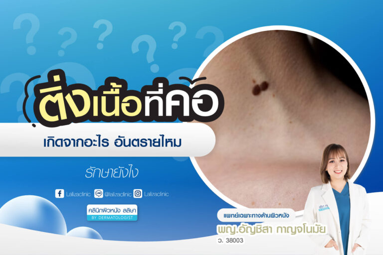 ติ่งเนื้อที่คอ สาเหตุและการรักษา