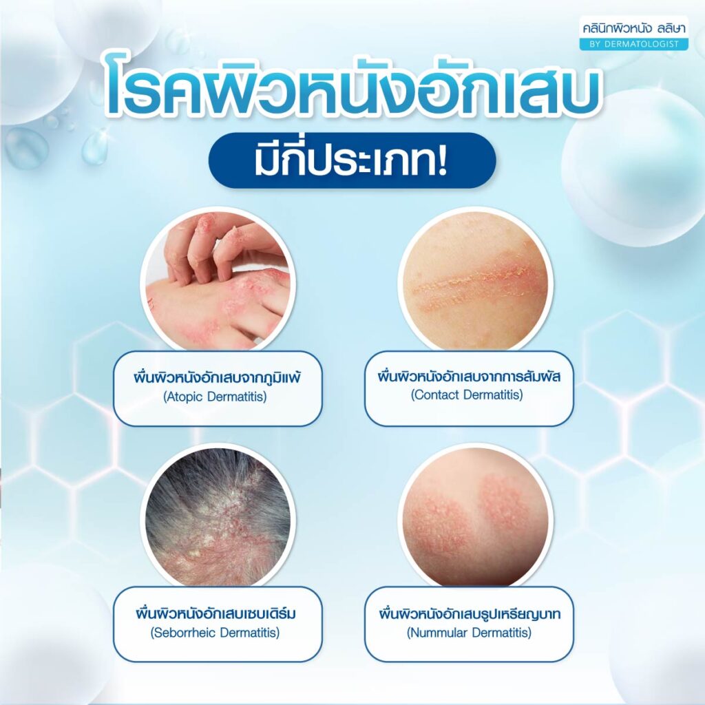 ประเภทโรคผิวหนังอักเสบ