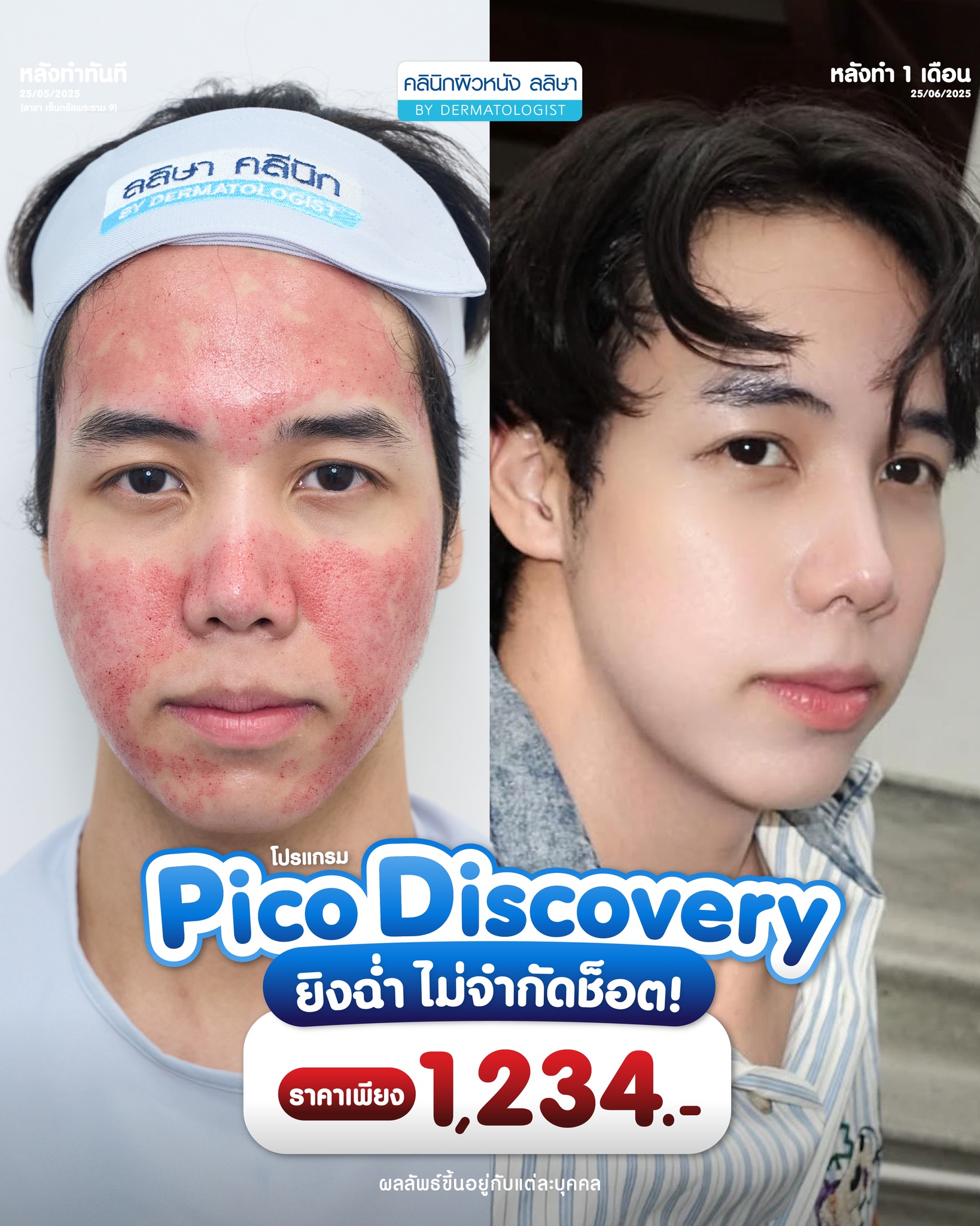 รีวิวผู้ชายทำ Pico Discovery