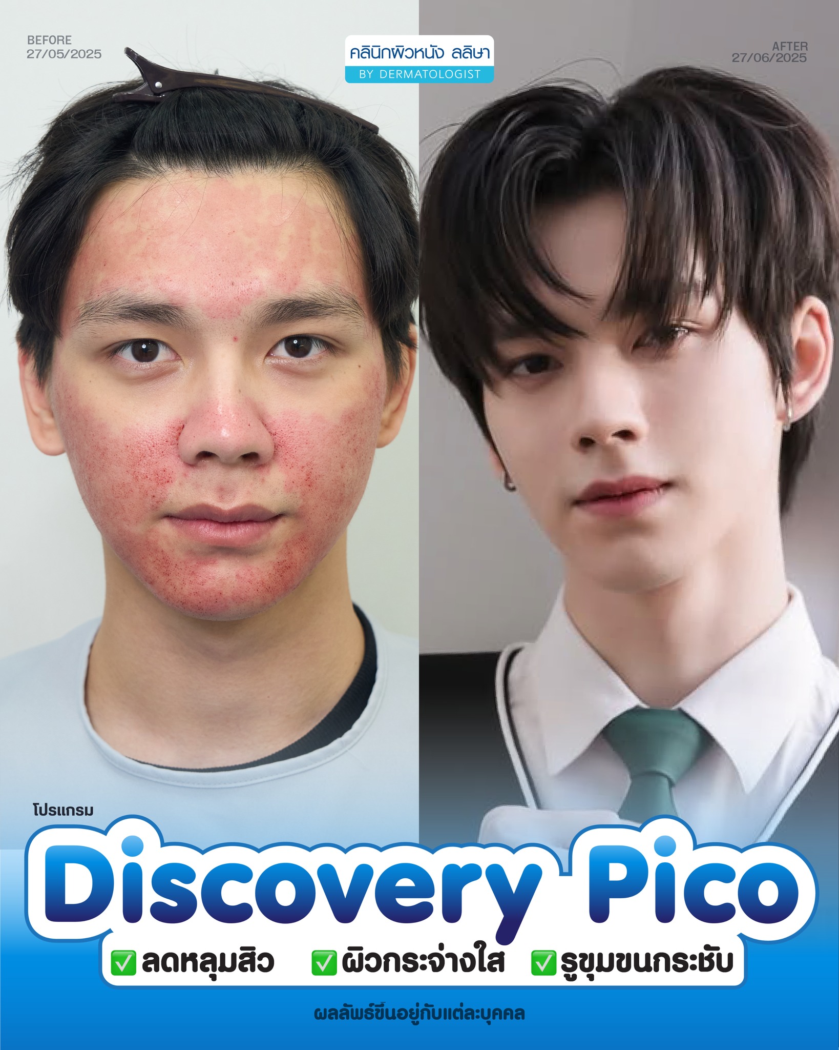 รีวิวผู้ชายอายุ 22 ทำ Pico Discovery
