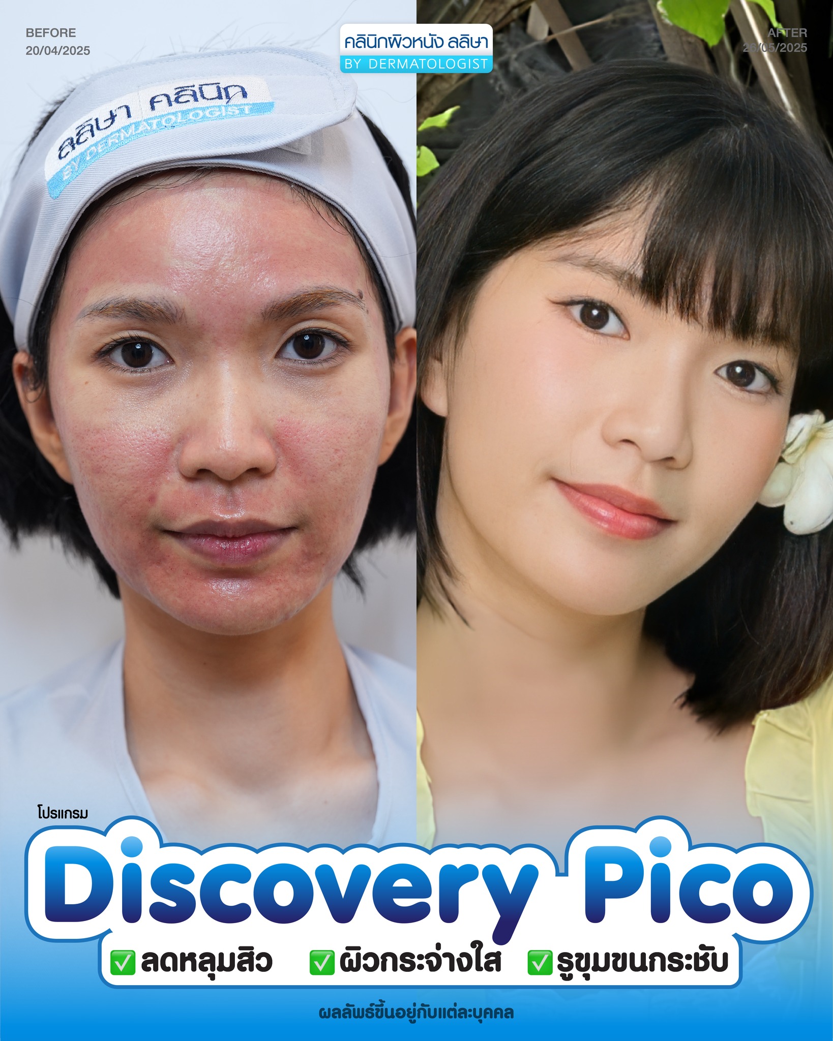 รีวิวผู้หญิงทำ Pico Discovery