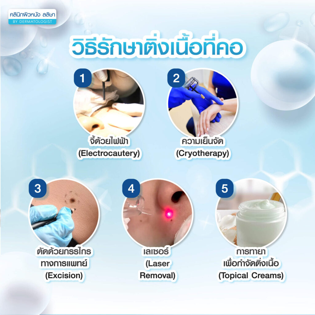 วิธีรักษาติ่งเนื้อที่คอ