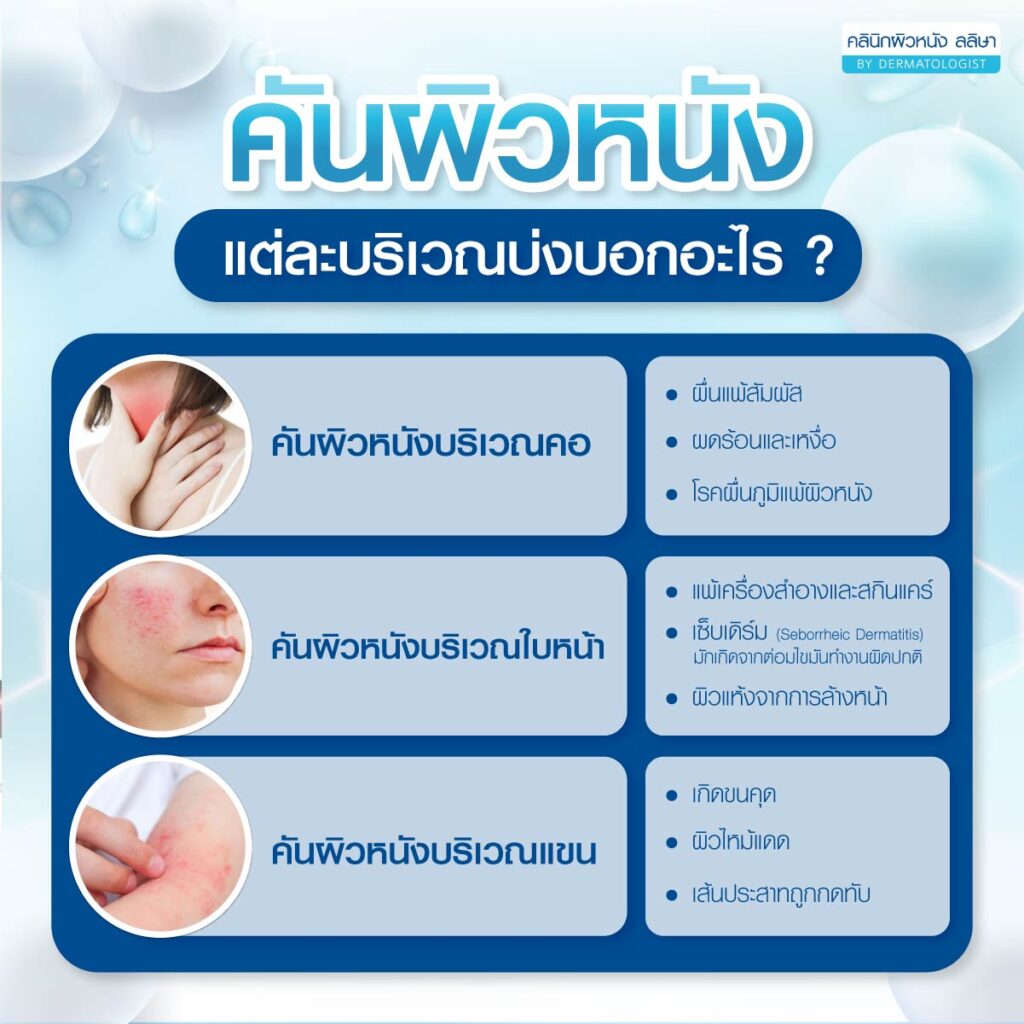 อาการคันผิวหนังแต่ละบริเวณ