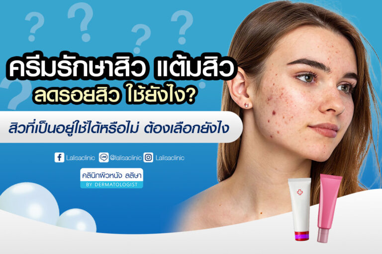 ครีมรักษาสิว แต้มสิว ลดรอยสิว ดีจริงไหม? ใช้ยังไง? สิวแบบไหนใช้ได้?