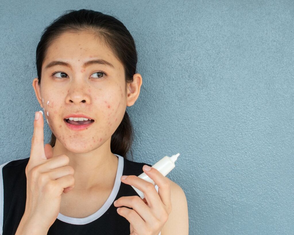 ความหมายครีมรักษาสิว