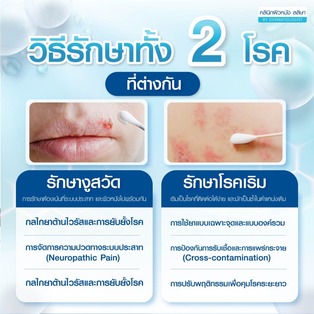 งูสวัดกับเริม การรักษา