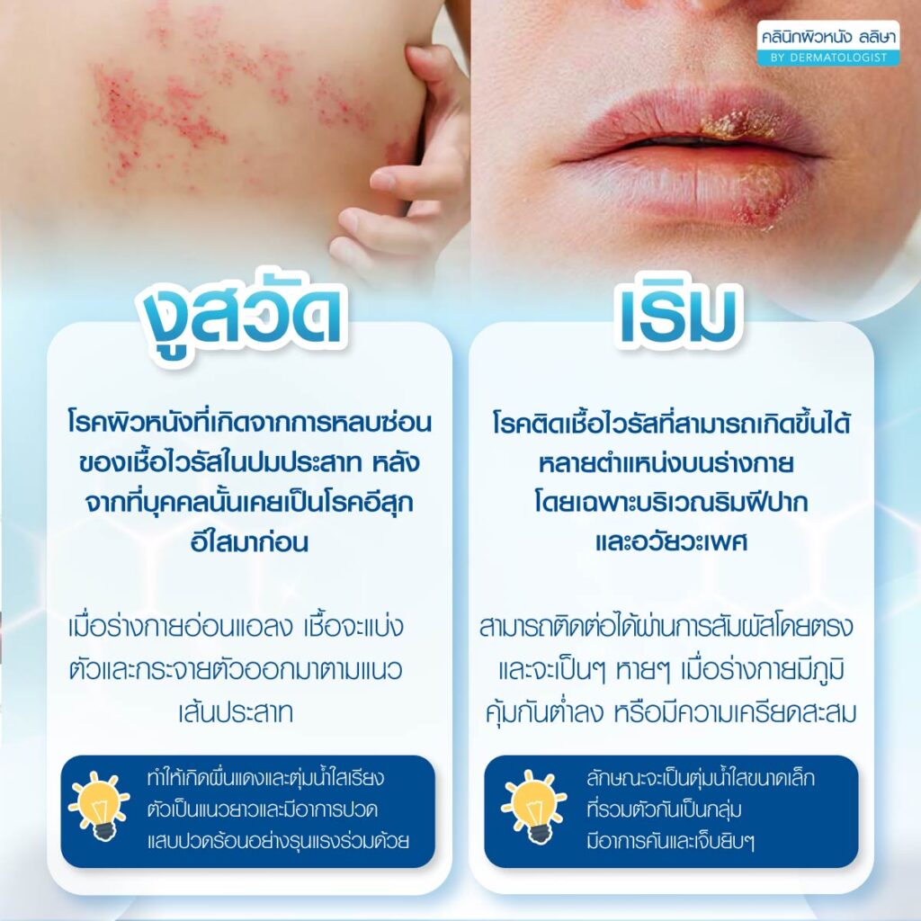 งูสวัดกับเริมต่างกันอย่างไร