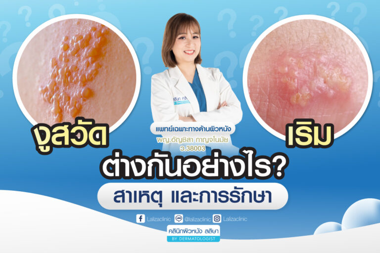 งูสวัดกับเริมต่างกันอย่างไร