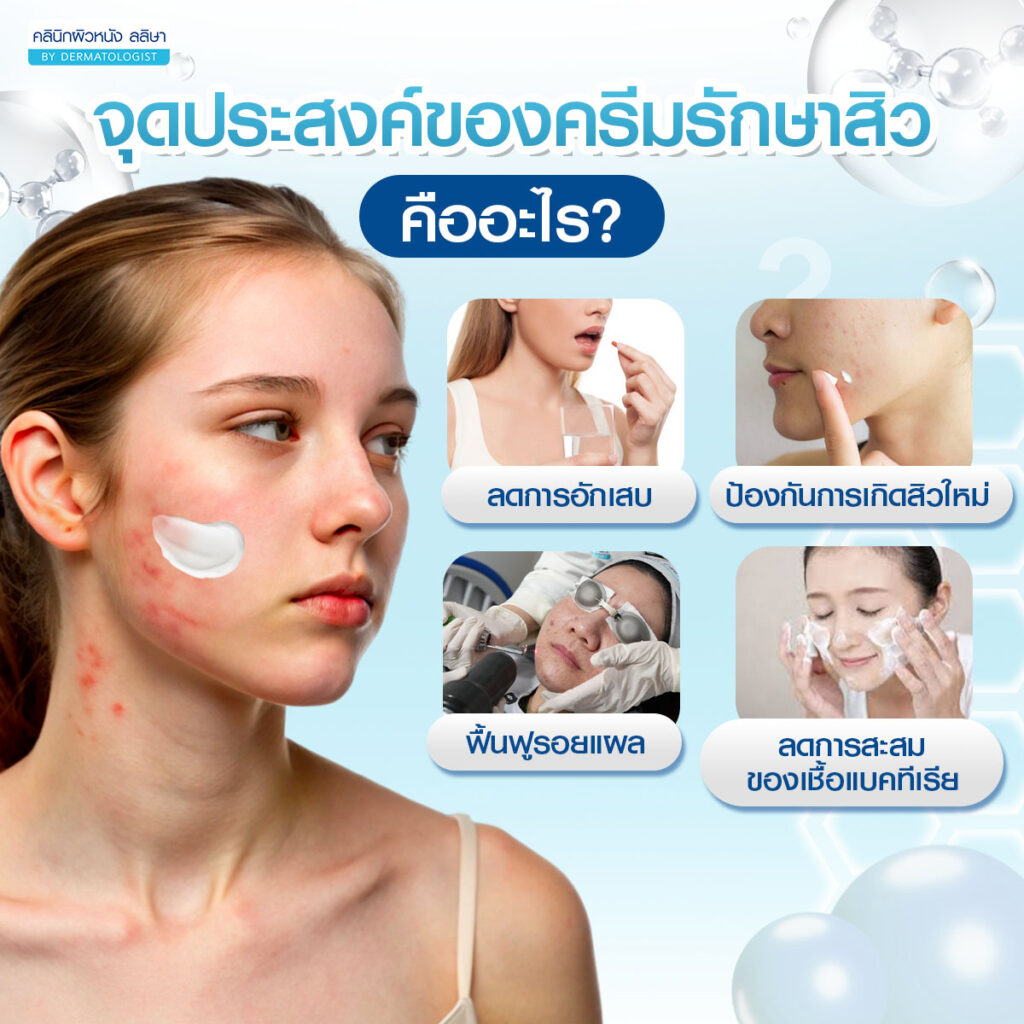 จุดประสงค์ของครีมรักษาสิว