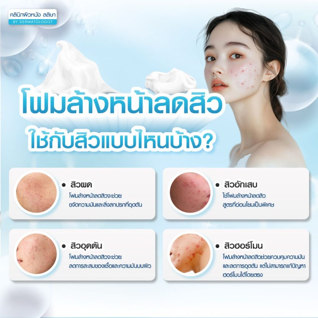 ประเภทสิวที่ใช้โฟมล้างหน้าลดสิวช่วยได้