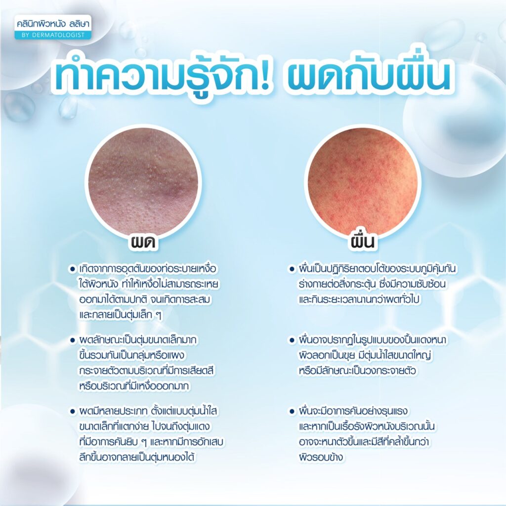 ผดกับผื่น