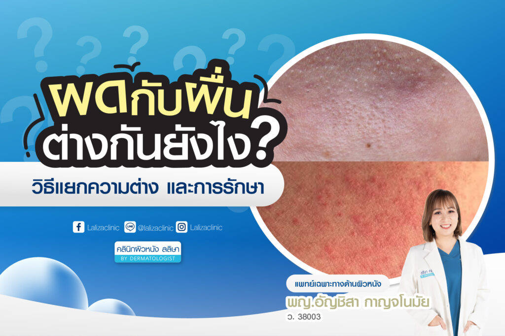 ผดกับผื่นต่างกันยังไง? วิธีแยกความต่าง และการรักษารูปปก