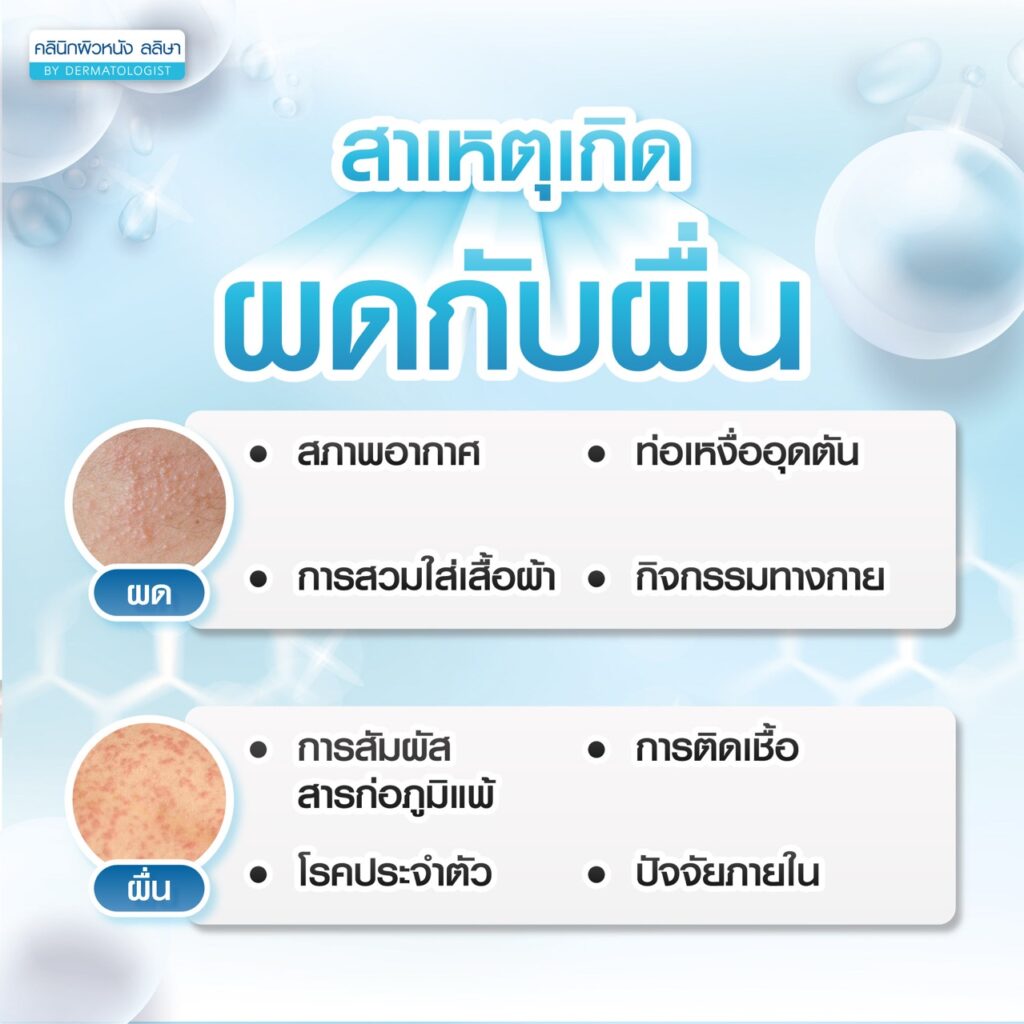 สาเหตุผดกับผื่น