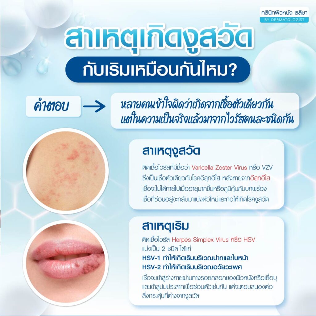 สาเหตุเกิดงูสวัดกับเริม