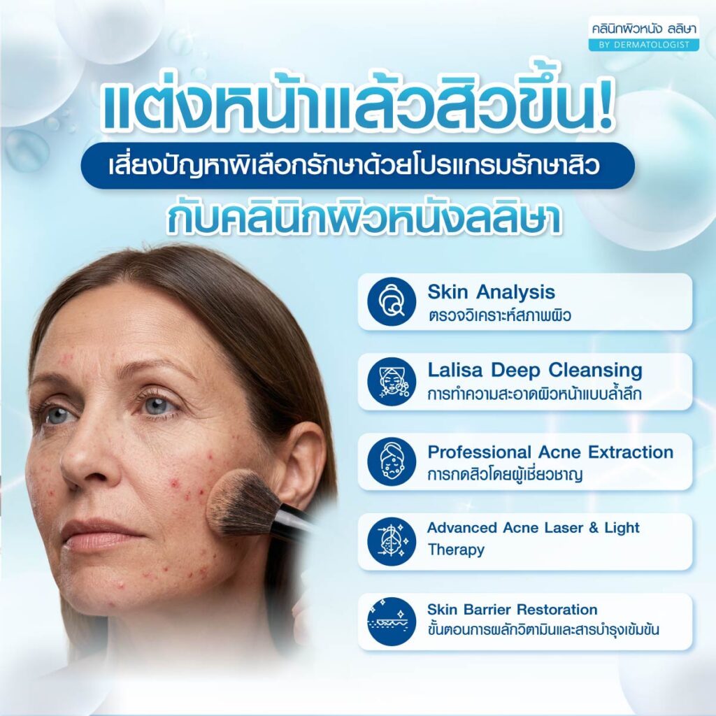 สิวขึ้นหลังแต่งหน้า รักษาด้วยโปรแกรมรักษาสิวของเรา