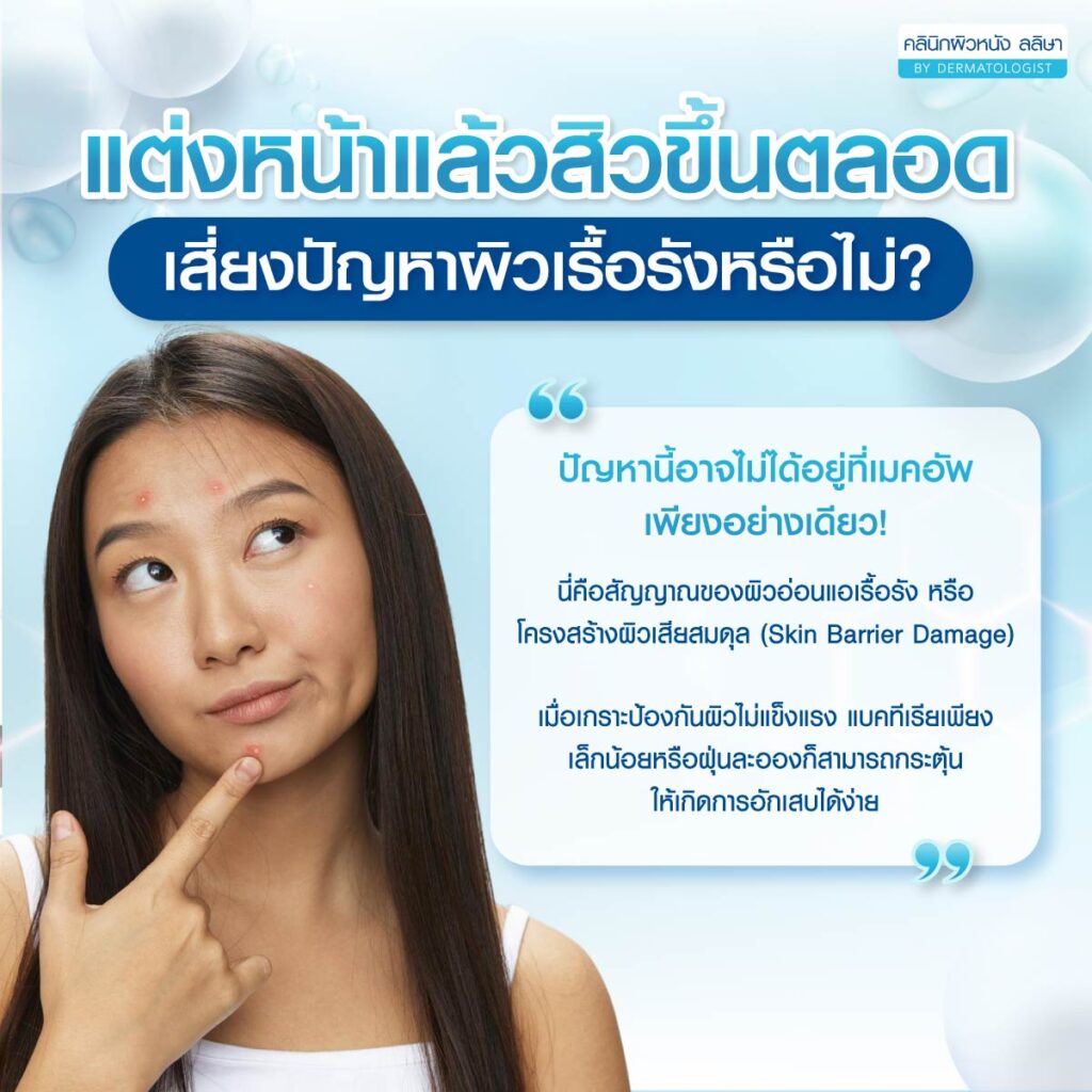 สิวขึ้นหลังแต่งหน้า เสี่ยงปัญหาผิวเรื้อรังไหม