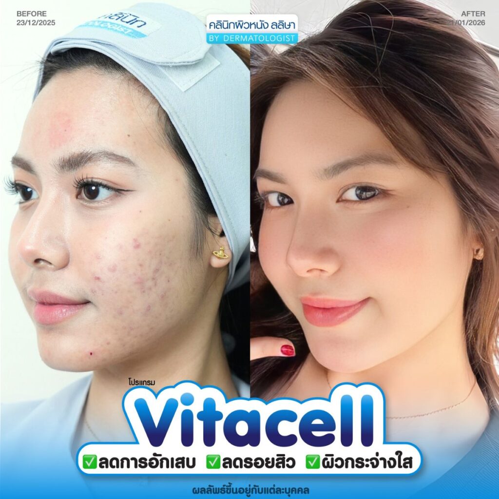 โปรแกรม Vitacell รีวิว