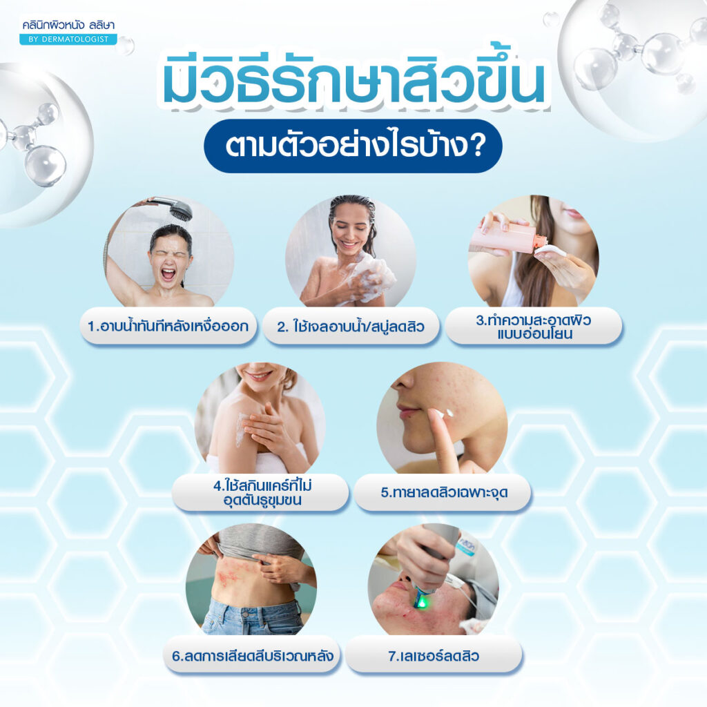 7 วิธีรักษาสิวขึ้นตัว