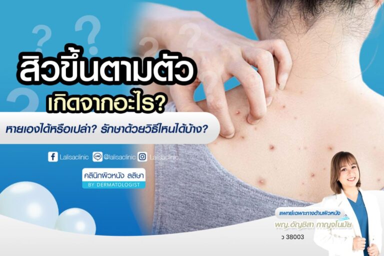 สิวขึ้นตามตัว เกิดจากอะไร? หายเองได้ไหม รักษาด้วยวิธีไหนได้บ้าง