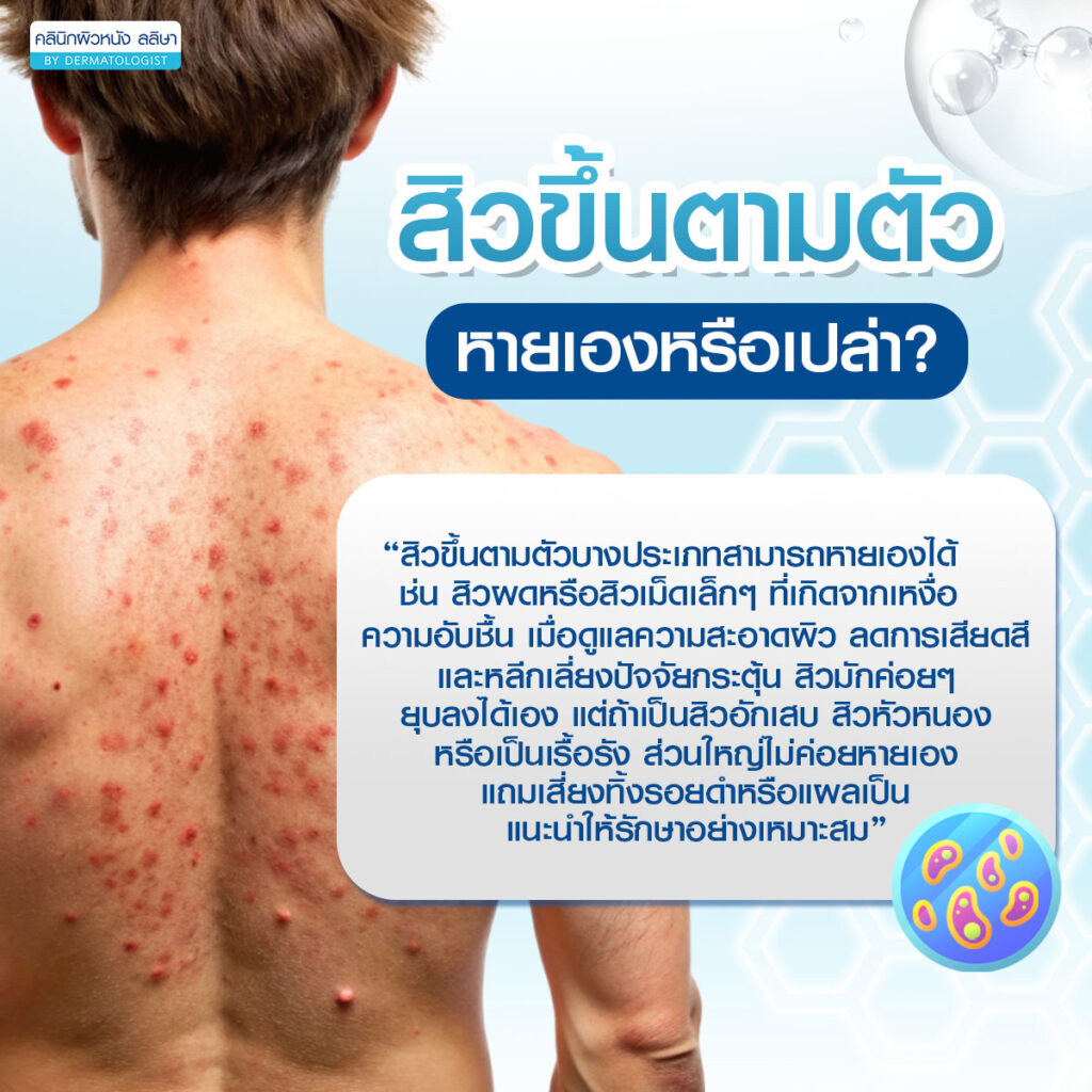 สิวขึ้นตามตัวหายเองไหม